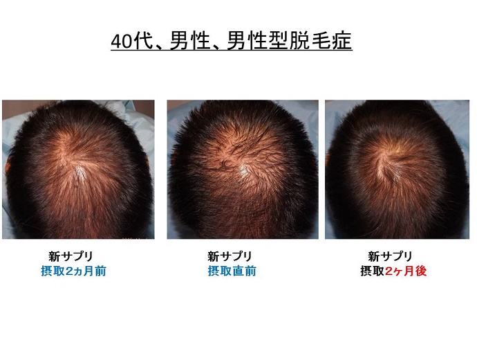男性型脱毛症　名医